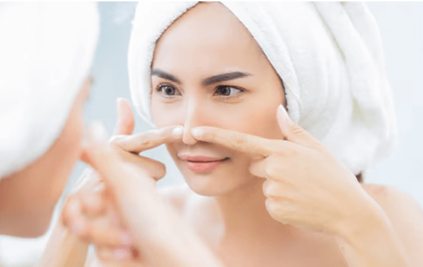 How to Treat and Prevent Blackheads Effectively